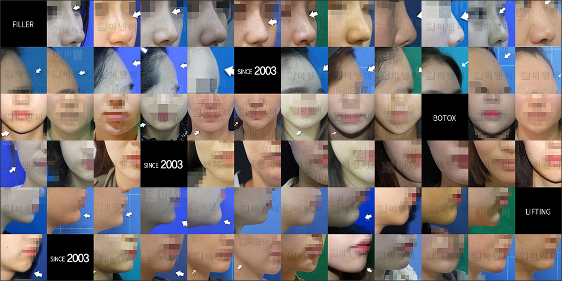 SINCE 2003 MI&MI, 시술후사진모음 신촌시크릿레이저,신촌역시크릿레이저